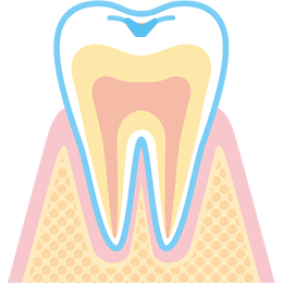 虫歯の進行段階